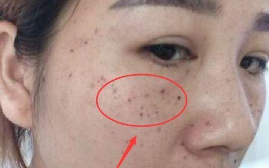 祛一个斑最有效方法激光还是嫩肤,什么斑适合做激光祛斑