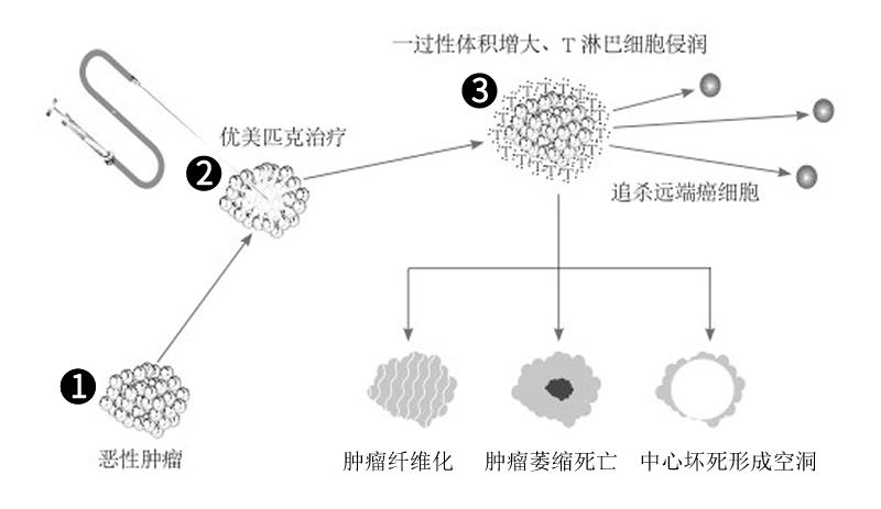 巨型肝癌晚期存活了5年,肝癌10厘米治愈案例