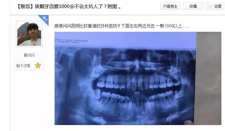 拔两颗智齿花了1800,一次性拔2颗下智齿