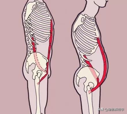 练瑜伽纠正骨盆前倾后腰椎受伤,练瑜伽前屈老是弓背怎么办