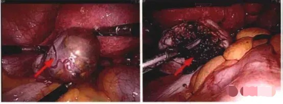 为什么近年来那么多宫外孕,宫外孕的5大症状你知道吗