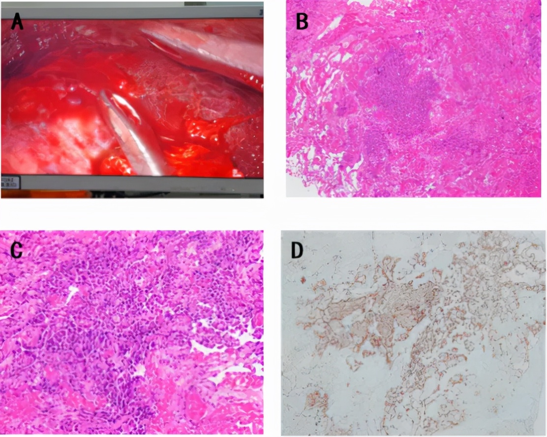 弥漫性肺泡出血能治好吗,弥漫性肺泡出血能活多久