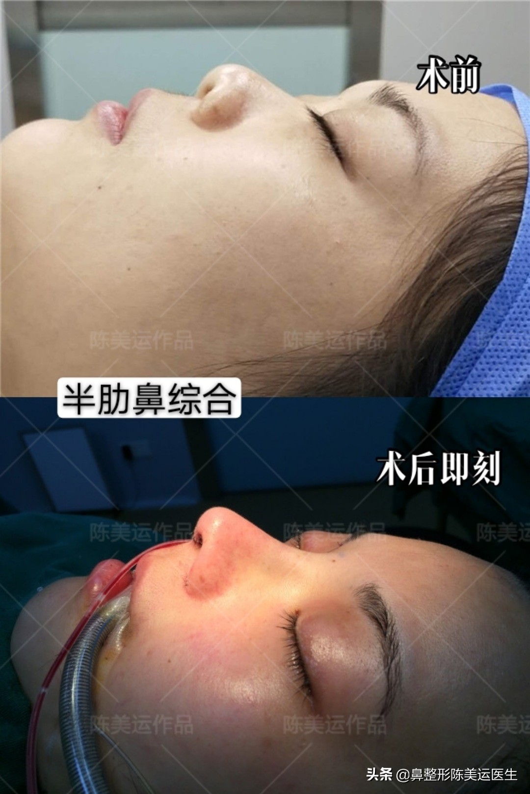 短塌鼻子可以做成直鼻吗,塌鼻子怎么能变成尖鼻子
