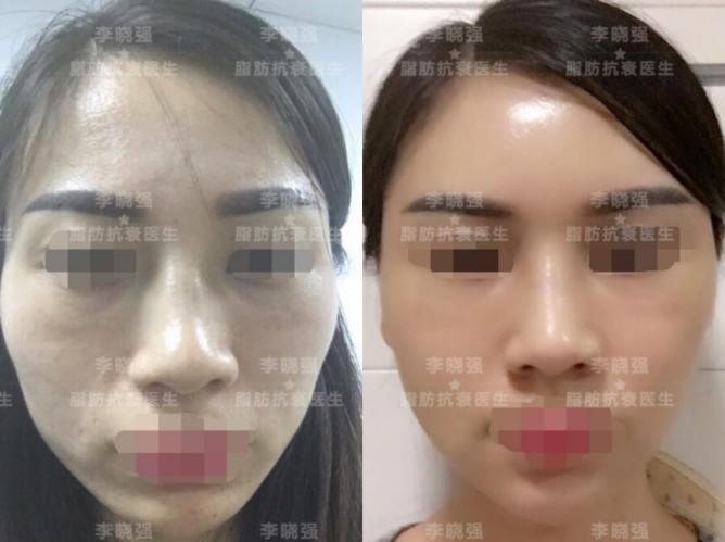 脸颊凹陷医美怎么改善,十全九美