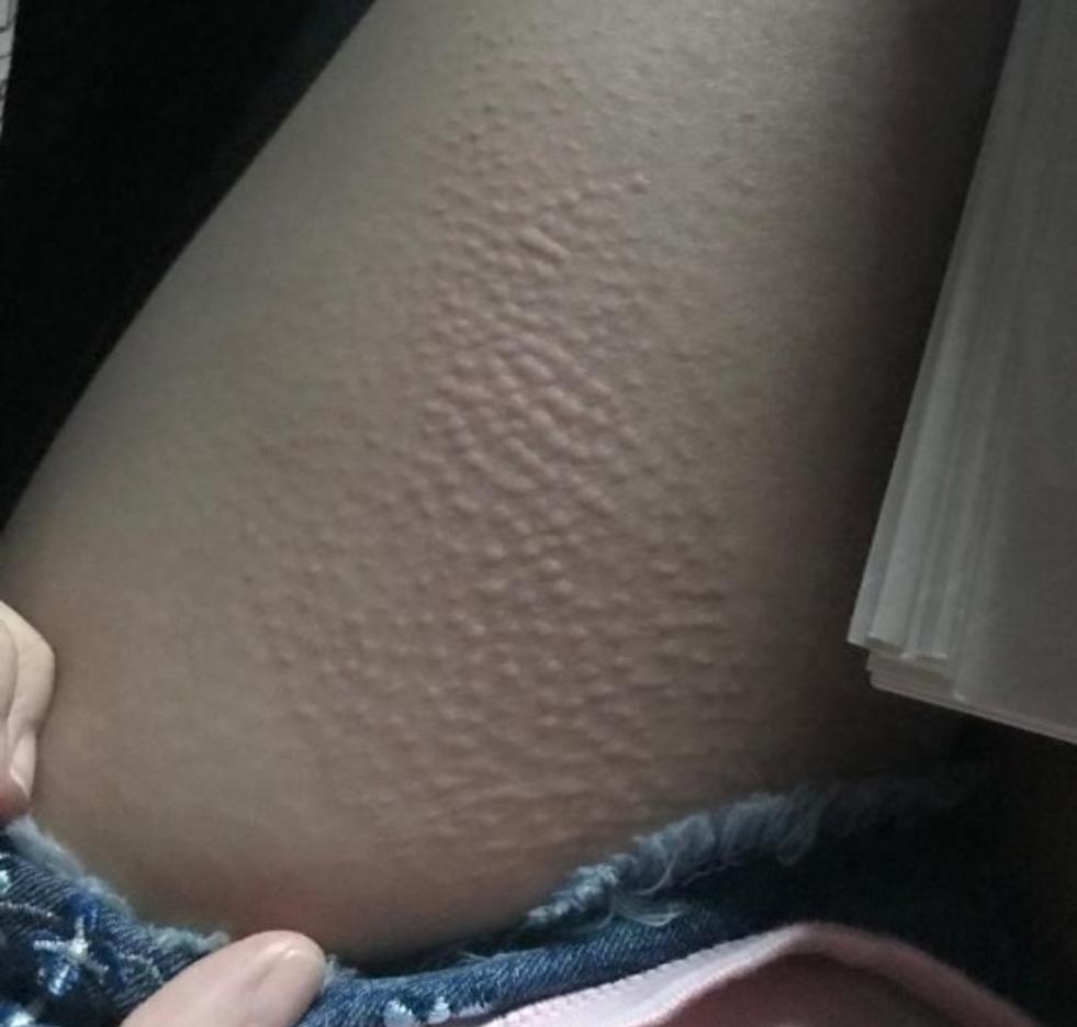 宅男女神邓月平戒口吃“草”曾荷尔蒙失调惹湿疹满身抓痕