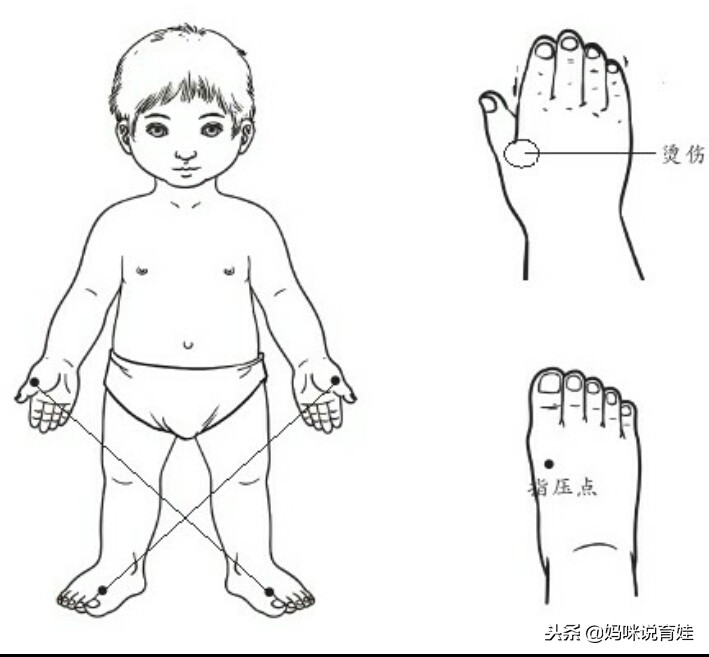 小孩火烫伤怎么处理,小宝宝烫伤皮掉了怎么处理好得快