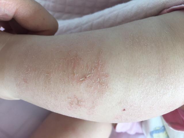 冬天宝宝怎么防皴裂,孩子冬天皮肤皲裂怎么办