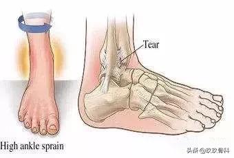 脚踝扭伤一个月后康复训练法,脚踝扭伤是否需要康复训练