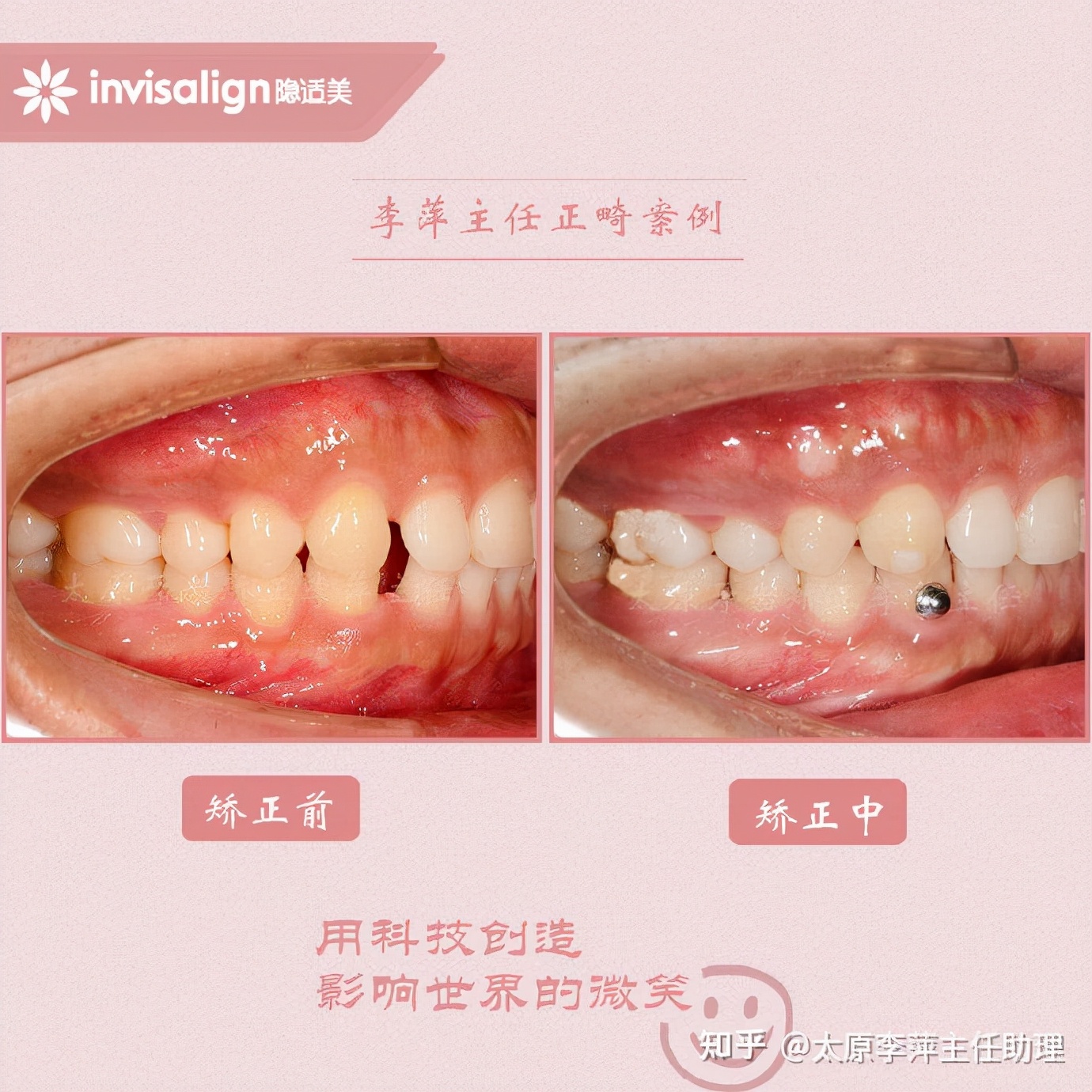 重度拥挤矫正牙齿适合隐形牙套吗,广州成人牙齿矫正推荐隐形牙套