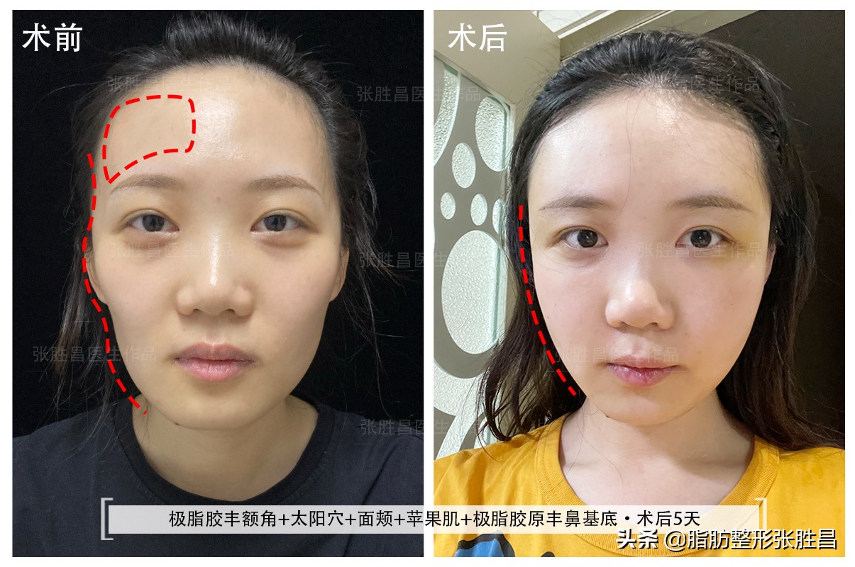 30岁龅牙矫正牙齿后脸型变化图,牙齿矫正使脸型凹陷会恢复吗