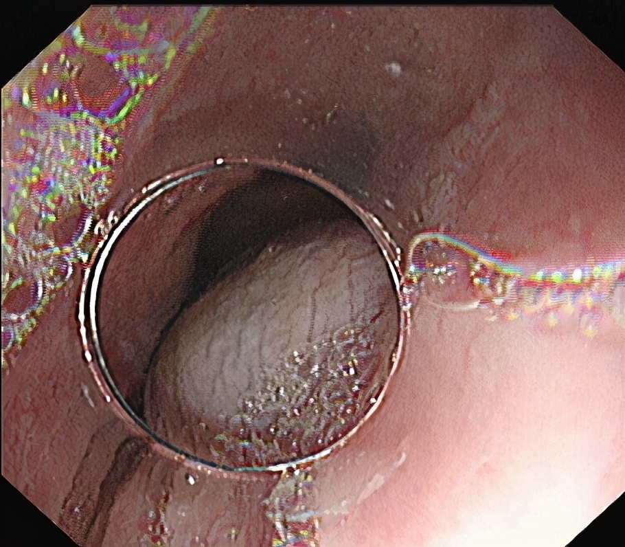 内镜下贲门失弛缓症微创手术,贲门失弛缓内镜治疗