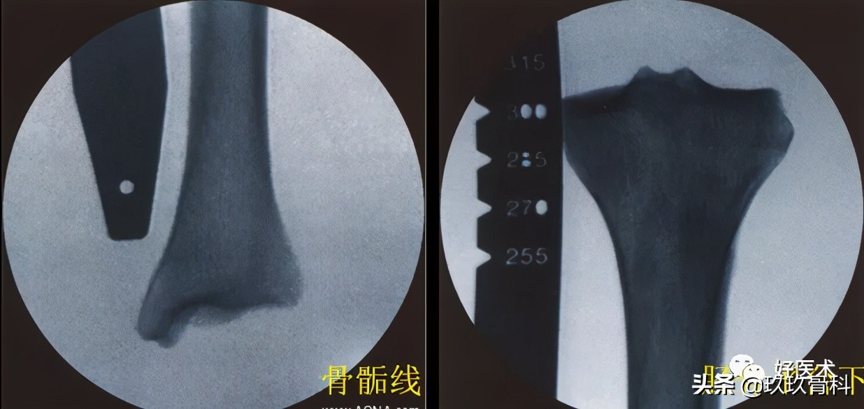 髓内钉技巧,髓内钉教学视频讲解