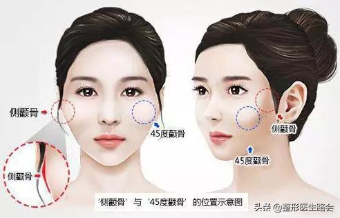 颧骨内推和颧弓有何区别,颧骨内推和颧突有什么区别