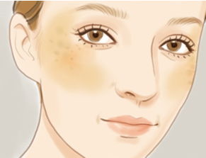 褐青色斑如何预防,褐斑如何防治