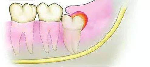 上火引起牙龈肿痛十大消炎药,牙龈肿痛吃了消炎药反而更严重了