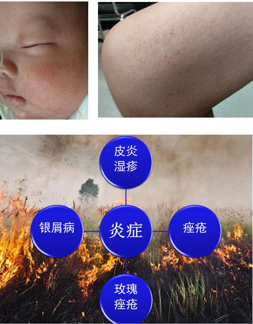 皮炎湿疹好了以后皮肤发红,湿疹反复发作能否转为皮炎