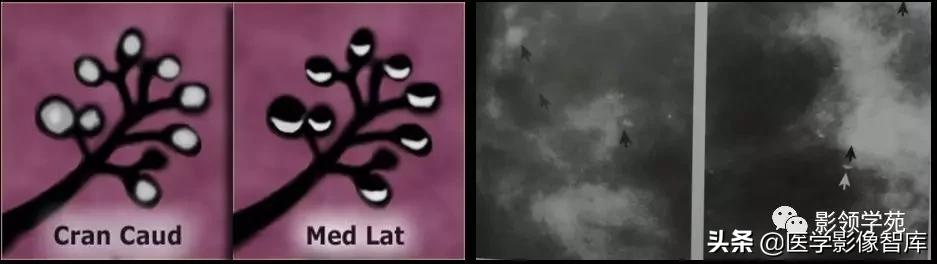 乳腺钙化怎么区分良性和恶性,乳腺钙化的诊断与分级