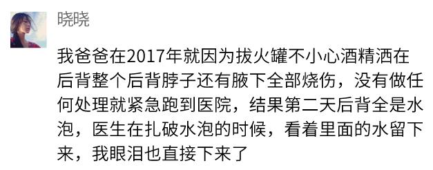邓莎被烧伤原因,邓莎拔火罐被烧伤视频
