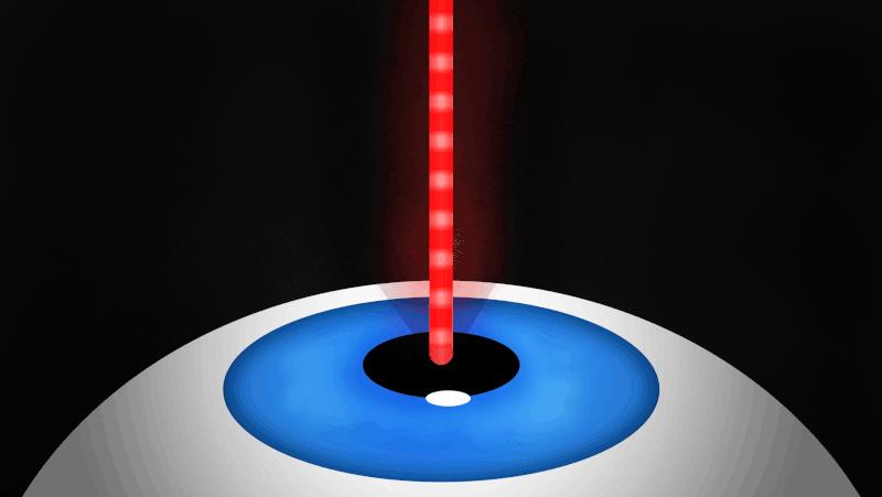 近视眼手术晶体移植和激光的区别,近视眼做了激光有什么利弊