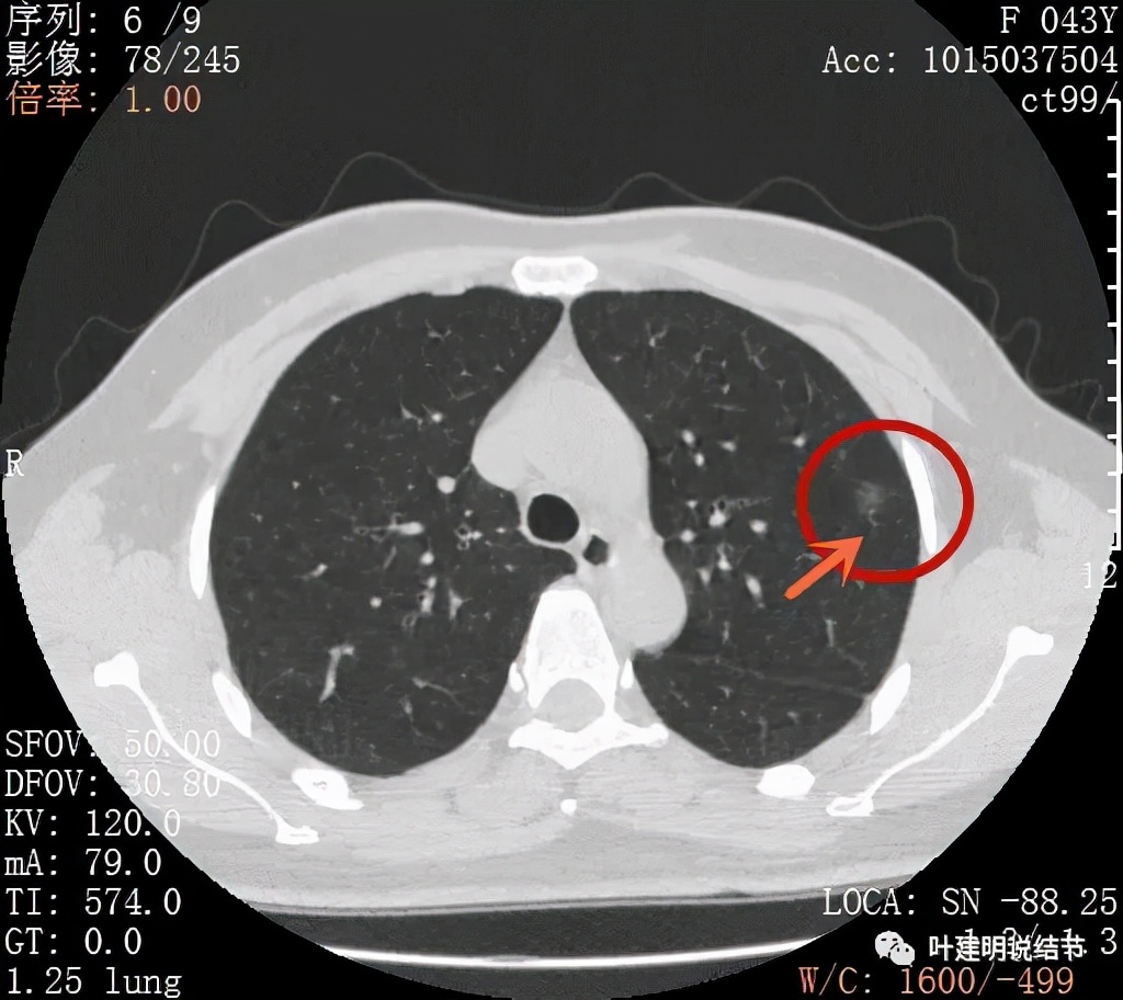 从活检怎么看是非小细胞癌,从病例谈辨证论治