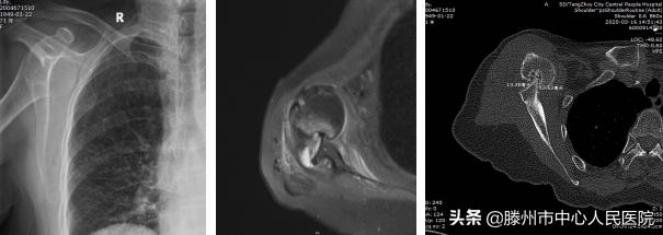 肩关节后脱位肩袖修补术,肩关节习惯性脱位修复手术评残