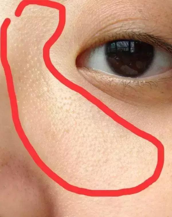 粉刺是什么应该怎么治,粉刺怎么样才算好了