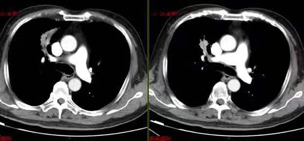 肺内见多发小囊状无纹理透光影,肺内肿块并厚壁空洞