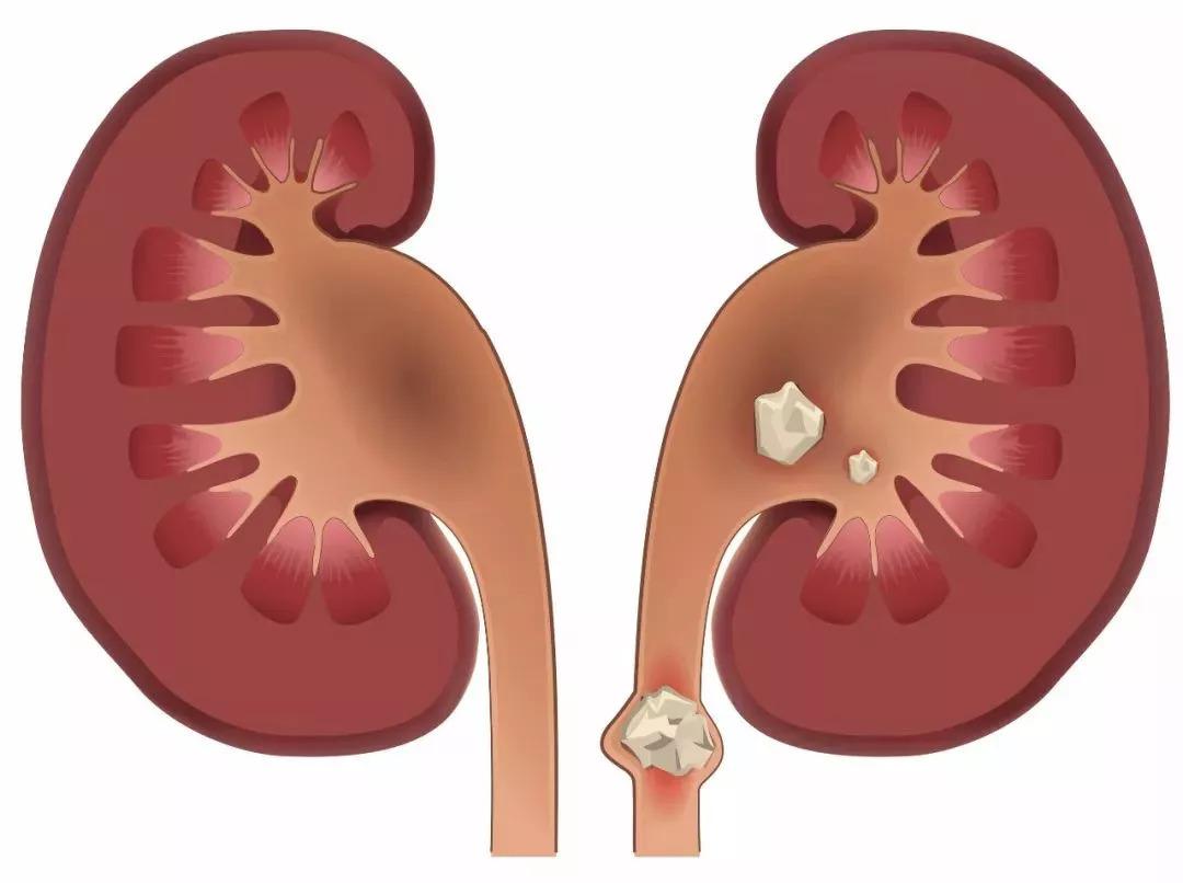 脂蛋白肾病发病机制,脂蛋白肾病是难治性肾病吗
