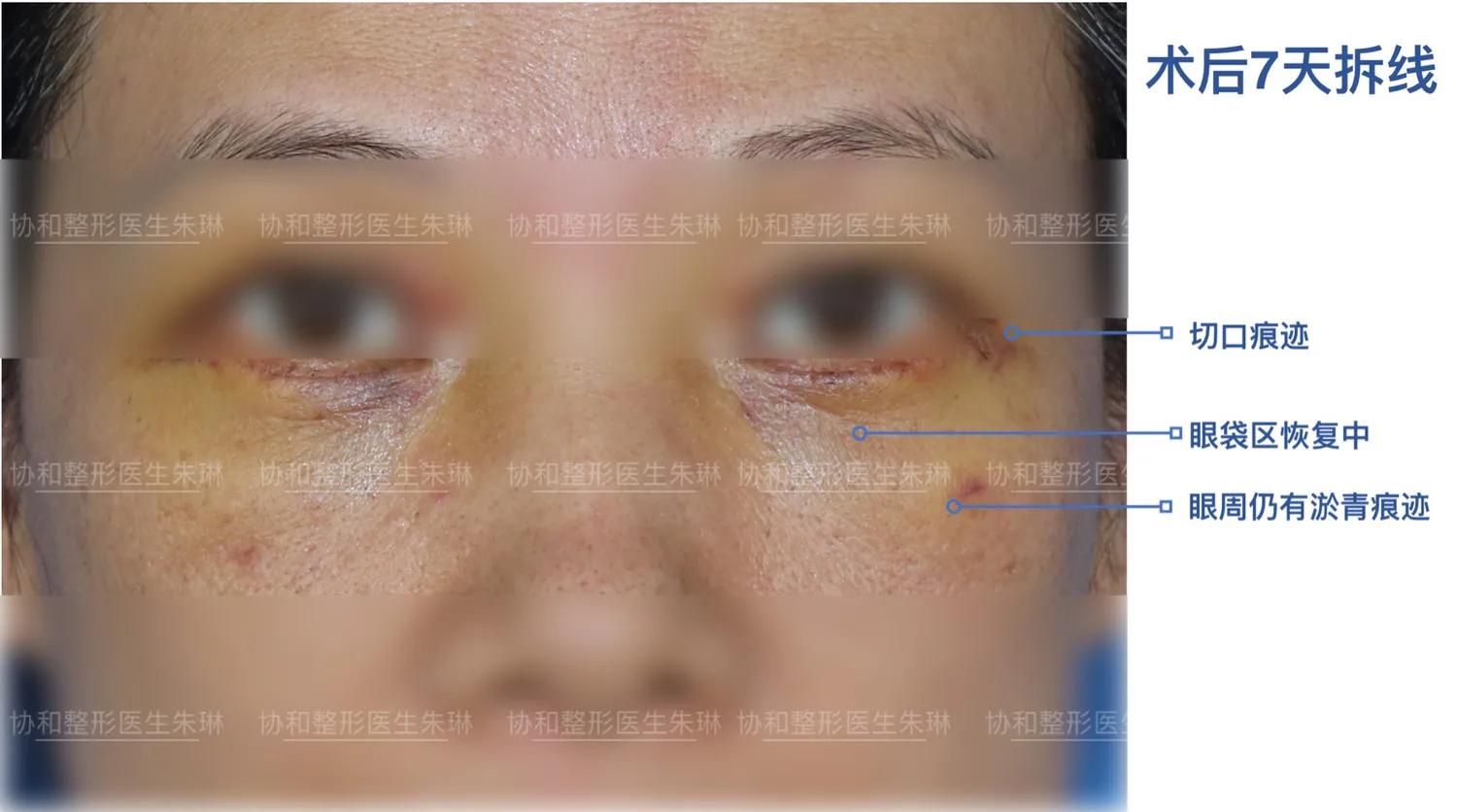 外切眼袋消肿食谱,外切眼袋20天效果图