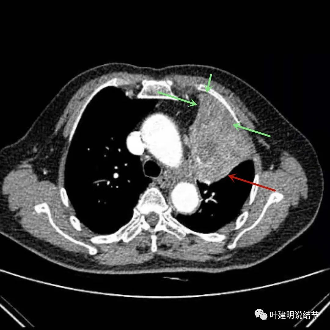 高龄肺癌靶向治疗效果,高龄老人肺癌早期适合放疗吗
