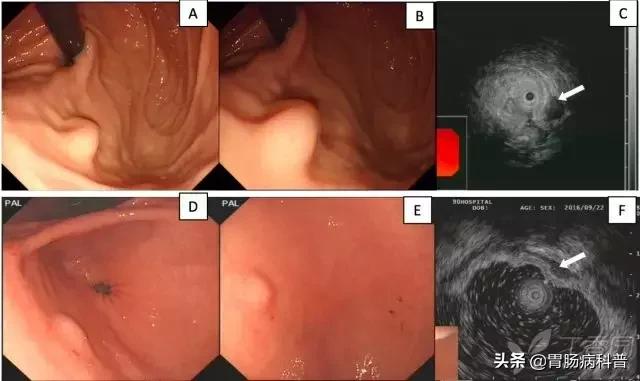 胃窦粘膜下隆起病变是胃癌吗,胃镜报告胃窦伴有隆起