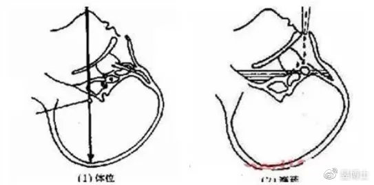 急性鼻窦炎和慢性鼻窦炎的区别,慢性鼻窦炎用什么消炎药有效果