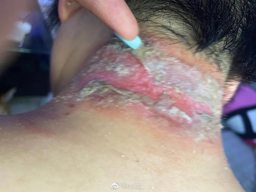 晚上玩手机会毁容的虫子,前一晚关灯玩手机被虫毁容