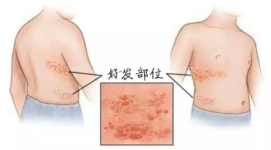 腰缠万贯到底是什么,腰缠万贯是什么病