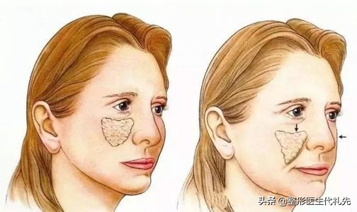 拉皮贴神器去法令纹有用吗,拉皮手术可以去除法令纹