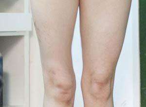 colles骨折石膏固定注意事项,骨折石膏外固定后改变是什么意思