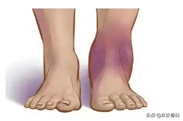 习惯性脚踝扭伤3年怎么治疗,习惯性扭伤脚踝隐隐作痛