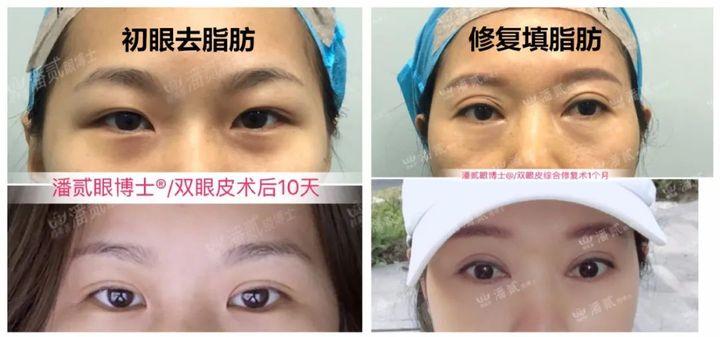做双眼皮手术后眉毛会变吗,做双眼皮手术的疤痕会消失吗