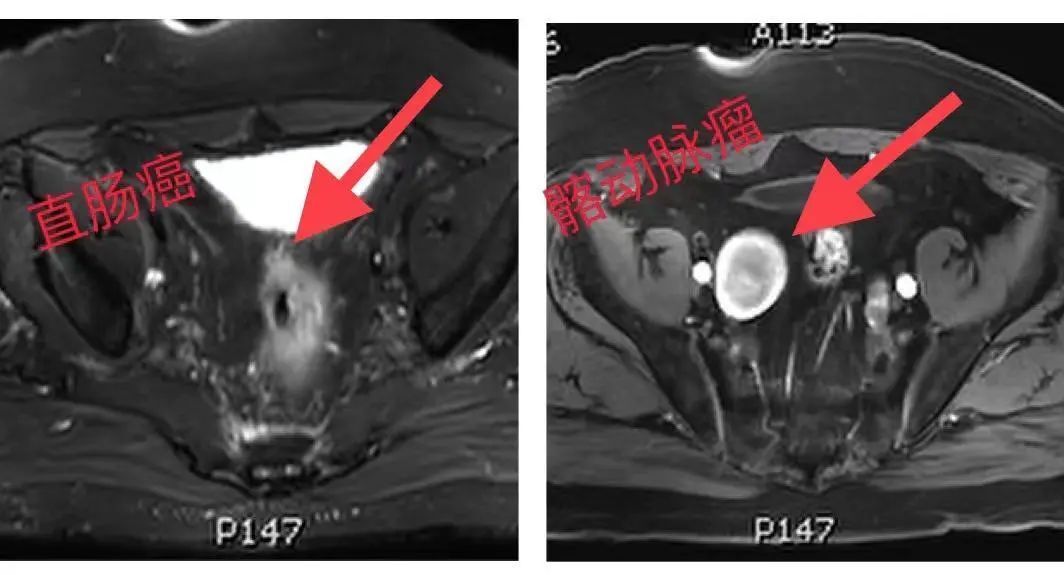 老人淋巴血管瘤的治疗方案,直肠癌血管瘤