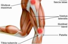 大腿外侧髂胫束综合征快速恢复,跑步如何避免髂胫束综合征