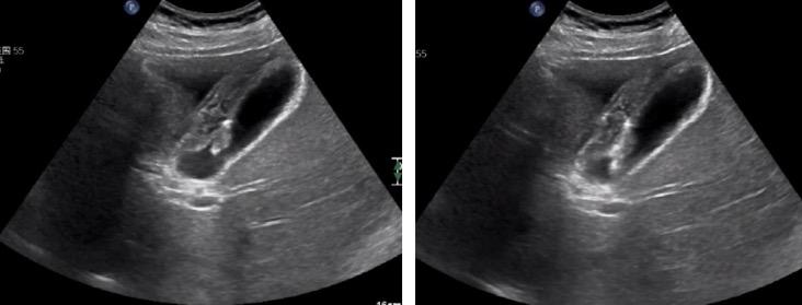 胆囊息肉消融保胆有效吗,胆囊息肉消融保胆有用吗