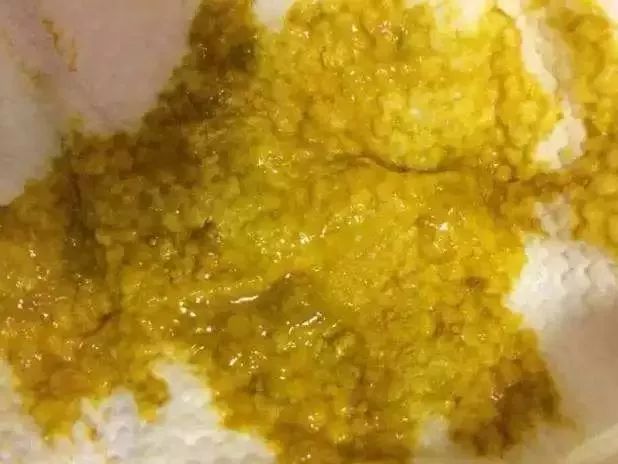 婴儿拉绿便的几种形状,宝宝拉绿便怎么鉴别