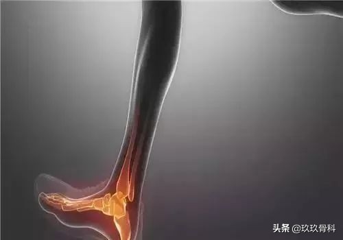 崴脚后遗症的三步恢复法,很多人的脚都崴伤