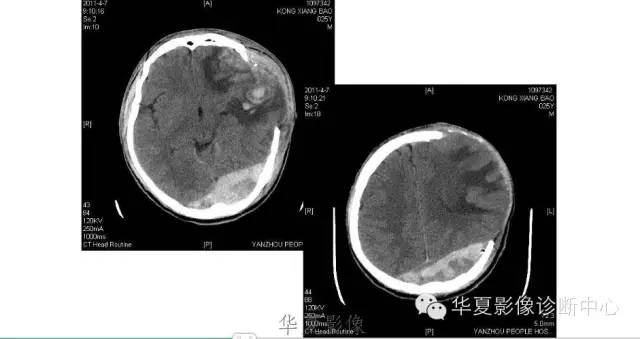 一文读懂颅内胆脂瘤,一文看懂背后的真相