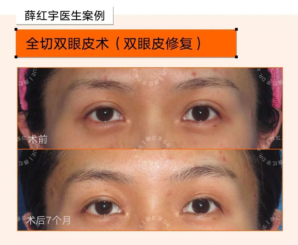 无痕双眼皮大概要多少钱,无痕双眼皮闭眼有痕