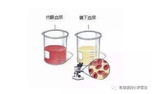 吃完火龙果血尿有哪些症状,血尿是不是火龙果造成