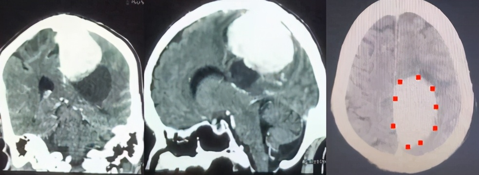 陕西102岁老人手术成功,医生切除77岁老人多个无病脏器