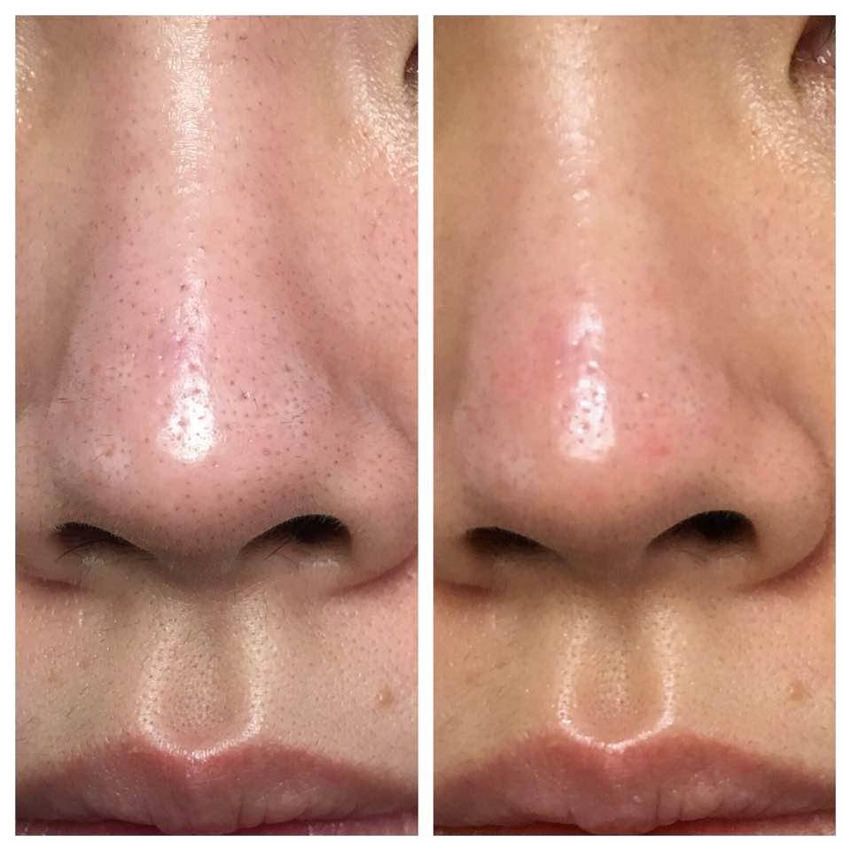 去黑头攻略：被黑头耽误的鼻子是该处理一下了