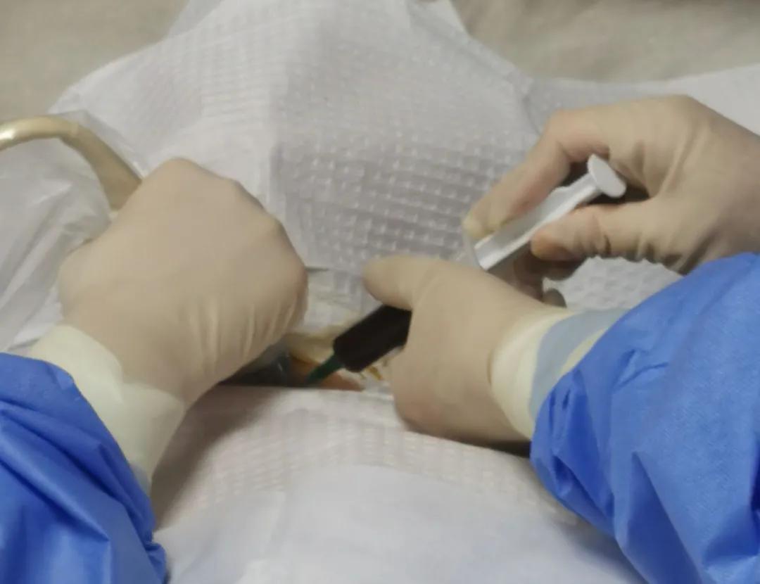 甲状腺囊肿介入,甲状腺囊肿介入治疗效果如何