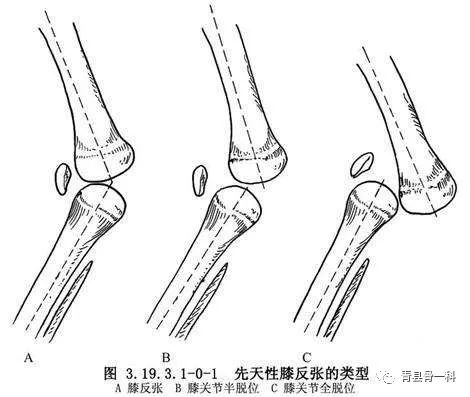 关节脱臼怎么预防,关节不小心扭到怎么休息